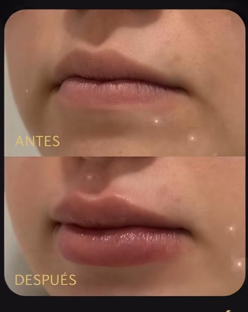 Labios de una paciente antes y después del relleno, mismo ángulo y misma luz.