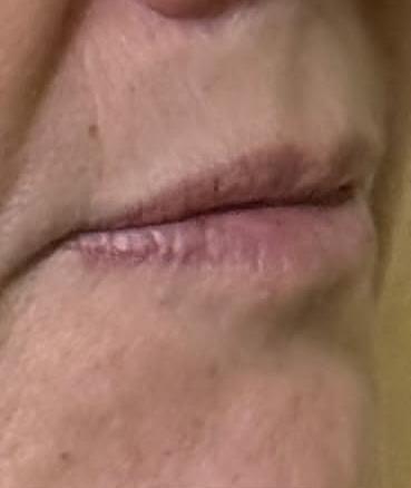 Labios de una paciente antes del relleno.
