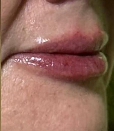 Los mismos labios después del relleno.