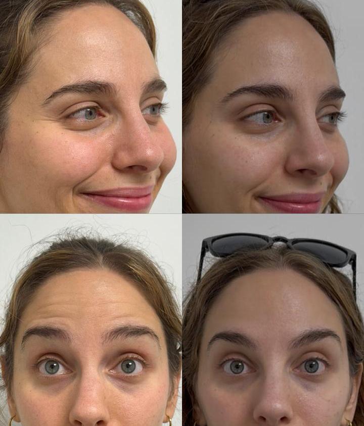 Rostro de una paciente antes y después de armonización facial con toxina botulínica, mismo ángulo y misma luz.