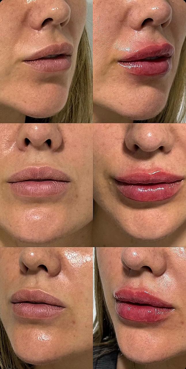 Labios de una paciente antes y después del relleno, en tres ángulos, mismo ángulo y misma luz.
